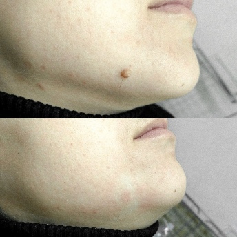 Vor und nach der Anwendung Skincell Pro